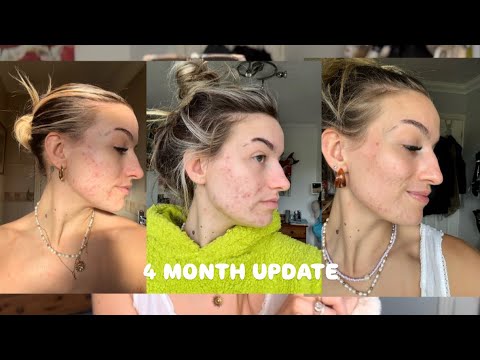 4 MONTH ROACCUTANE UPDATE | MY TOUGHEST BATTLE YET